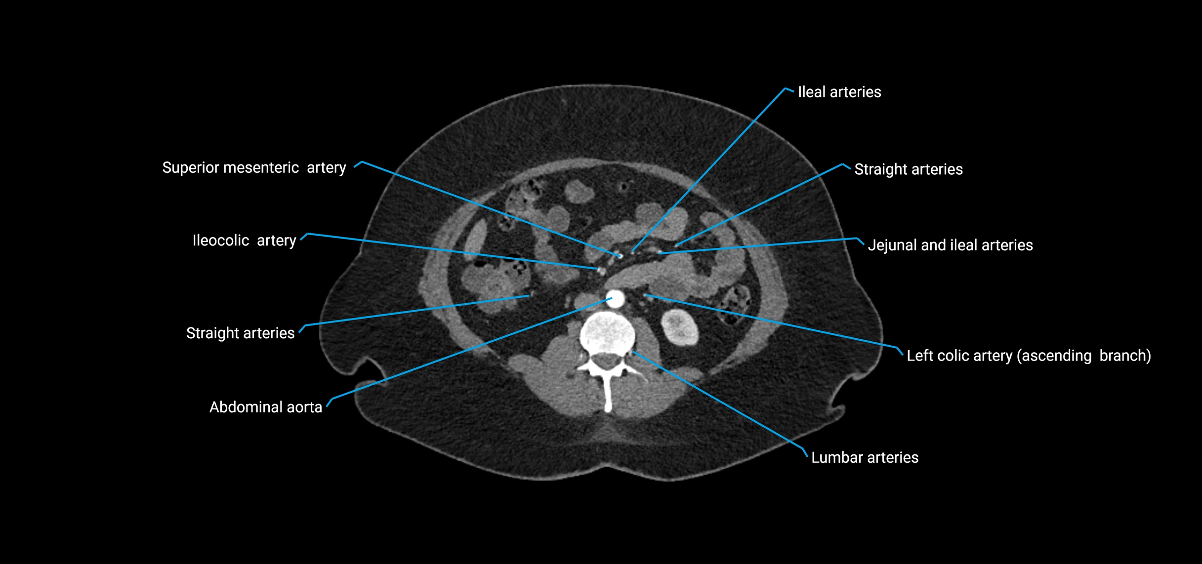CTA abdomen axial cross sectional anatomy labelled image_100 (2).webp